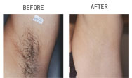 laser hair removal monmouth county nj laser hair removal monmouth county nj